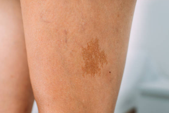 Brown Pigmentation On Lower Legs Cause Treatments Beautypolicy